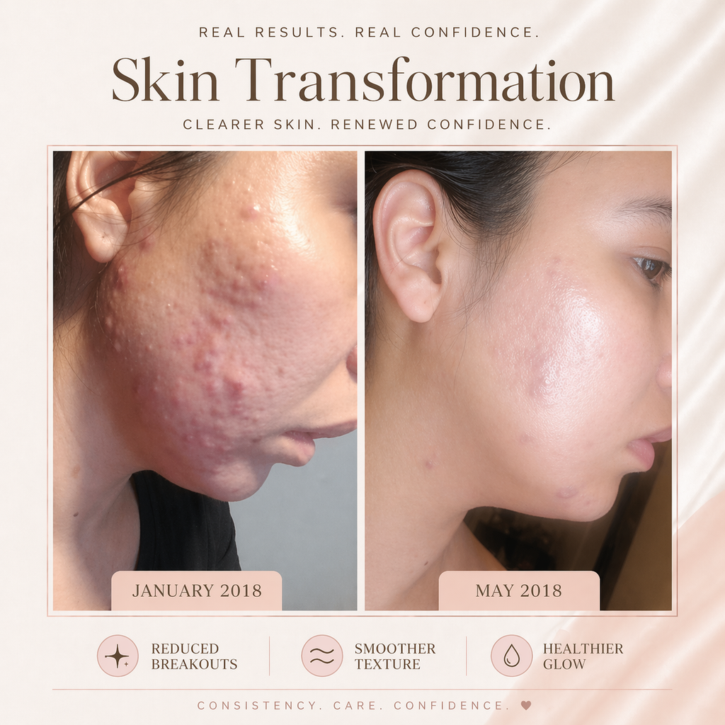 Acne Fighter Face Oil for Blemish-Prone Skin