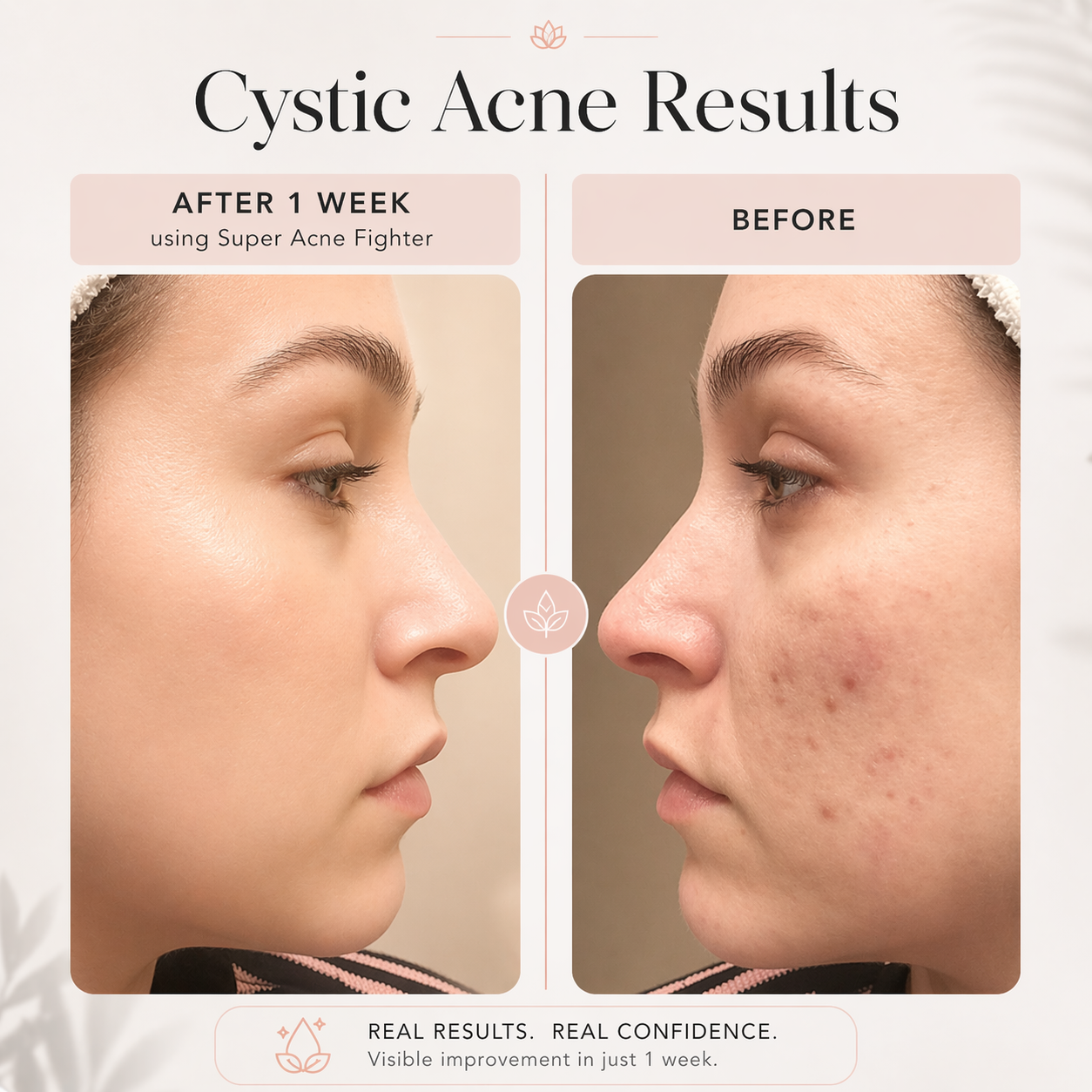 Acne Fighter Face Oil for Blemish-Prone Skin