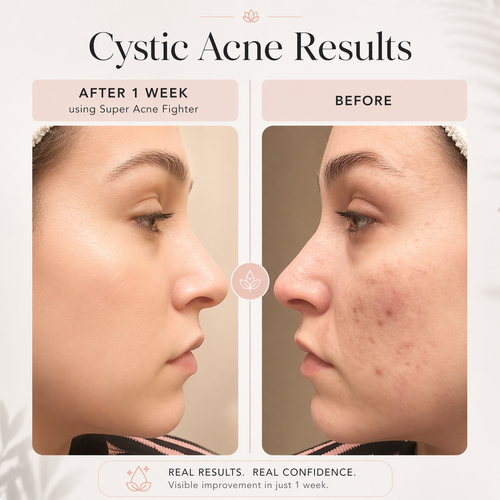 Acne Fighter Face Oil for Blemish-Prone Skin